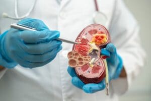 Kidney disease, Chronic kidney disease ckd, Doctor hold model to study and treat in hospital.